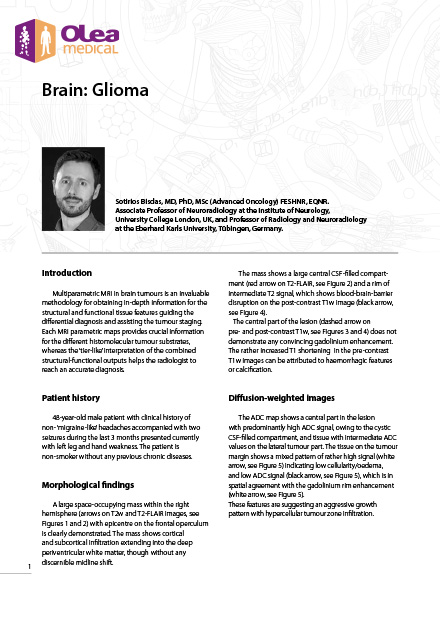 Olea case report: Brain: Glioma