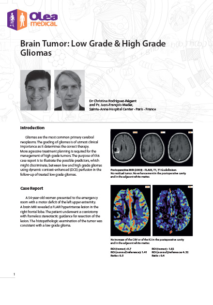 Olea case report: Brain Tumor: Low Grade & High Grade Gliomas