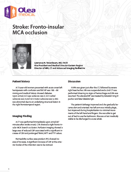 Stroke: Fronto-insular MCA occlusion