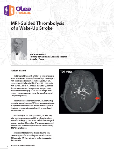 Olea case report: MRI-Guided Thrombolysis of a Wake-Up Stroke