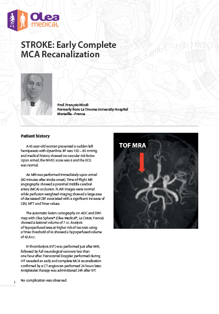 Stroke: Early Complete MCA Recanalization