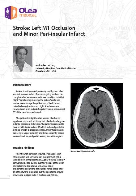 Stroke: Left M1 Occlusion and Minor Peri-insular Infarct