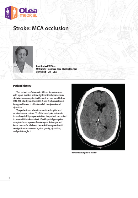 Stroke: MCA occlusion