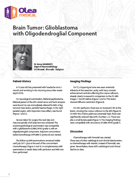 Olea case report: Brain Tumor: Glioblastoma with Oligodendroglial Component