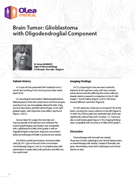 Brain Tumor: Glioblastoma with Oligodendroglial Component