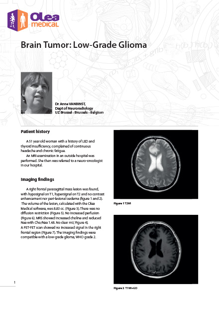Olea case report: Brain Tumor: Low-Grade Glioma