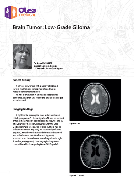 Brain Tumor: Low-Grade Glioma