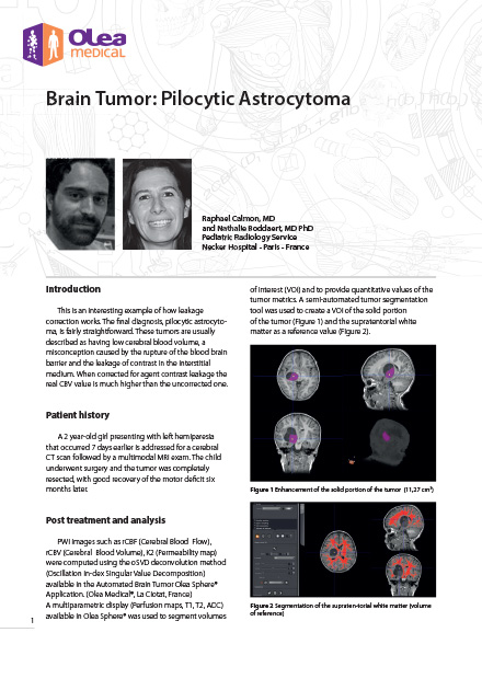 Brain Tumor: Pilocytic Astrocytoma