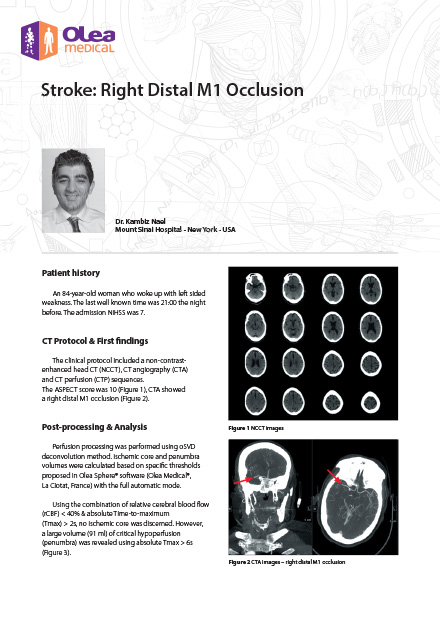 Stroke: Right Distal M1 Occlusion