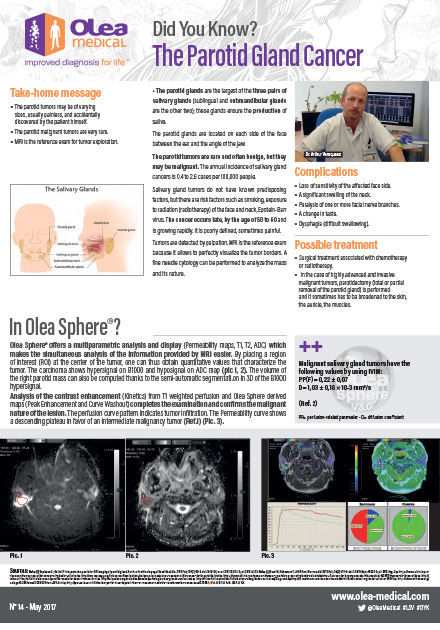 Parotid Gland Cancer