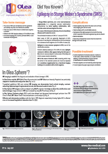 Epilepsy in Sturge Weber’s Syndrome (SWS)