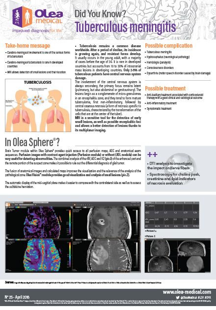 Tuberculous Meningitis