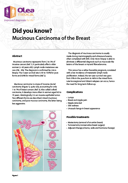 Mucinous Carcinoma of the Breast
